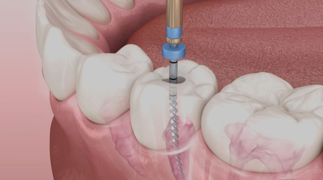 endodontia-04